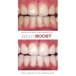 Ultradent Opalescence BOOST PF 40% Ofis Tipi Beyazlatma 4'lü Şırınga
