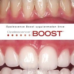 Ultradent Opalescence BOOST PF 40% Ofis Tipi Beyazlatma 4'lü Şırınga