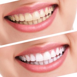 Ultradent Opalescence PF 16% Ev Tipi Beyazlatma 2'li Şırınga